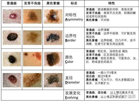 臉頰長痣|痣是什麼？會變成黑色素瘤？7種一定要除的痣